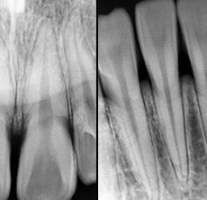치과표준 방사선 사진